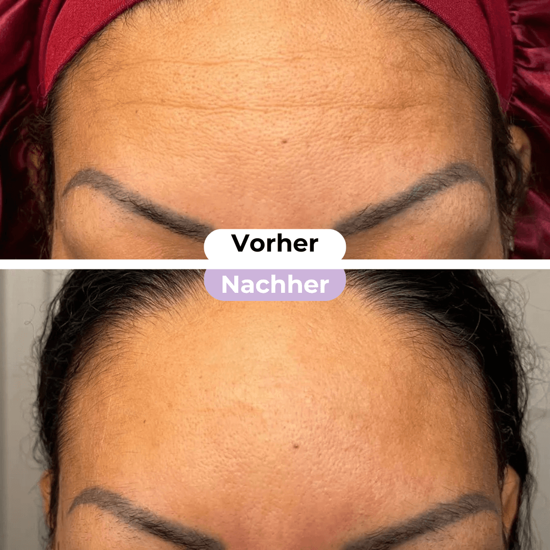 ScarRelief ™ | Silikone-arplaster